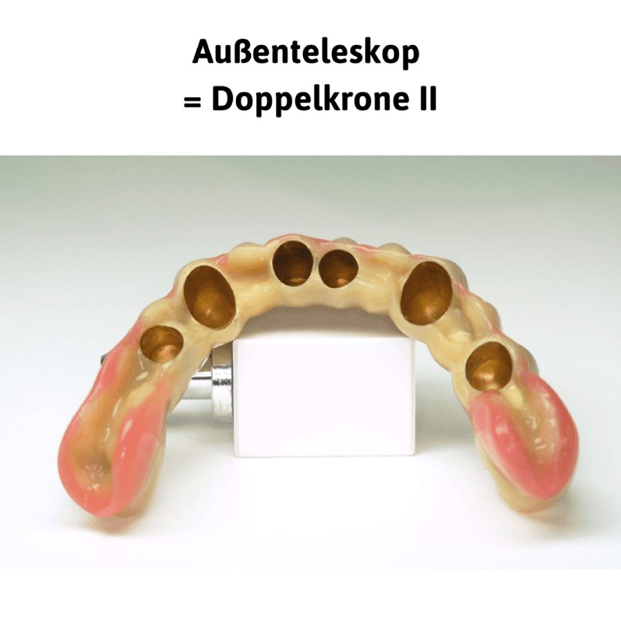 Außenteleskop = Doppelkrone II: herausnehmbare Zahnreihe