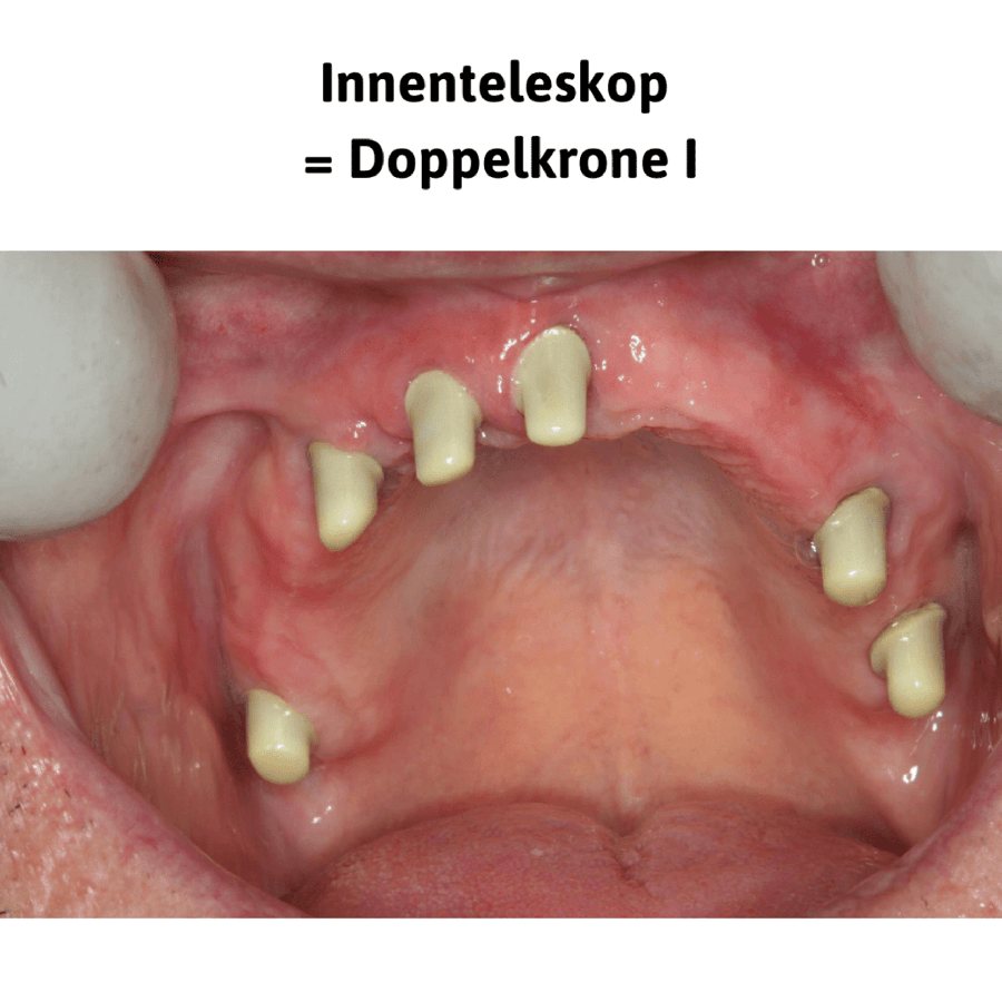 Innenteleskop = Doppelkrone I: beschliffene Pfeilerzähne im Oberkiefer